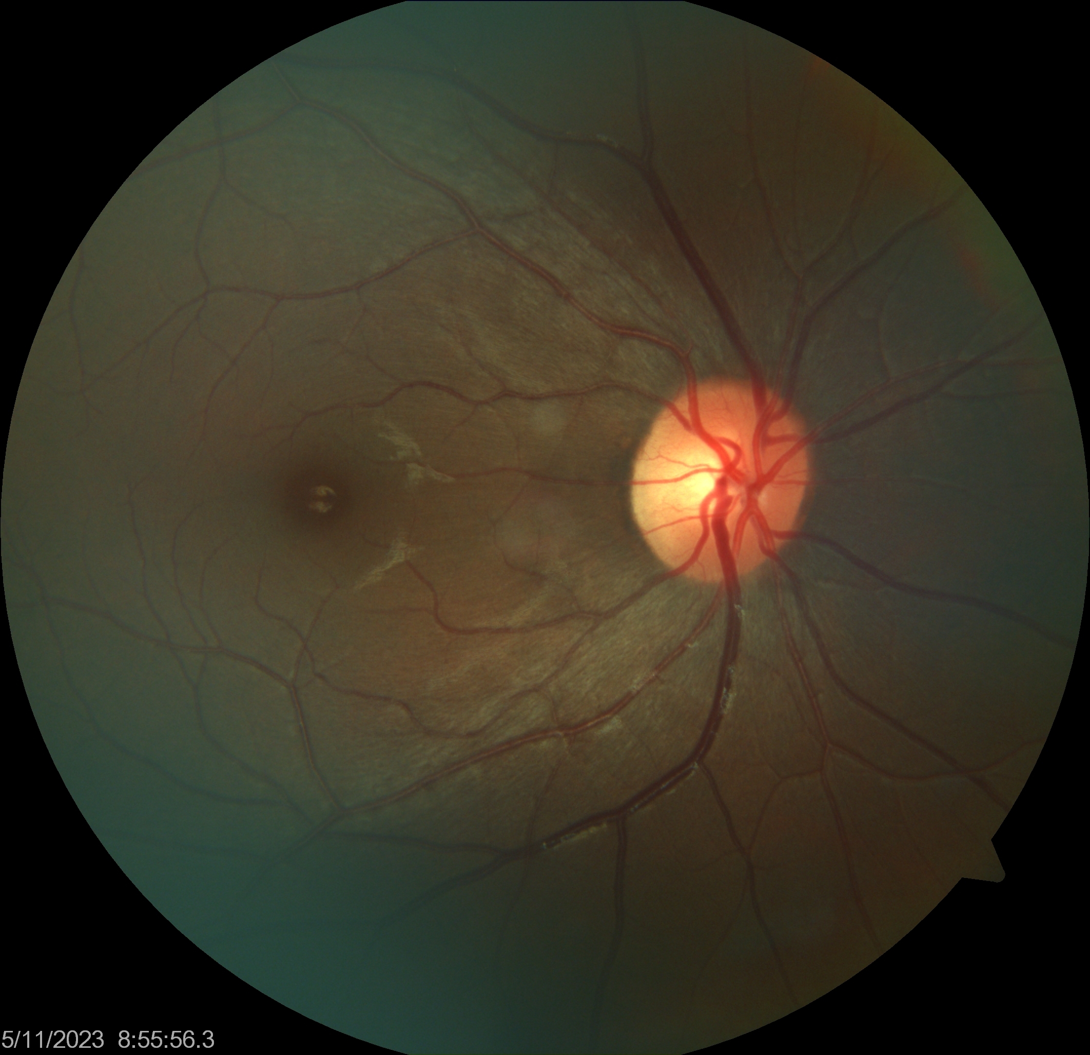 test-glaucoma-image.jpg