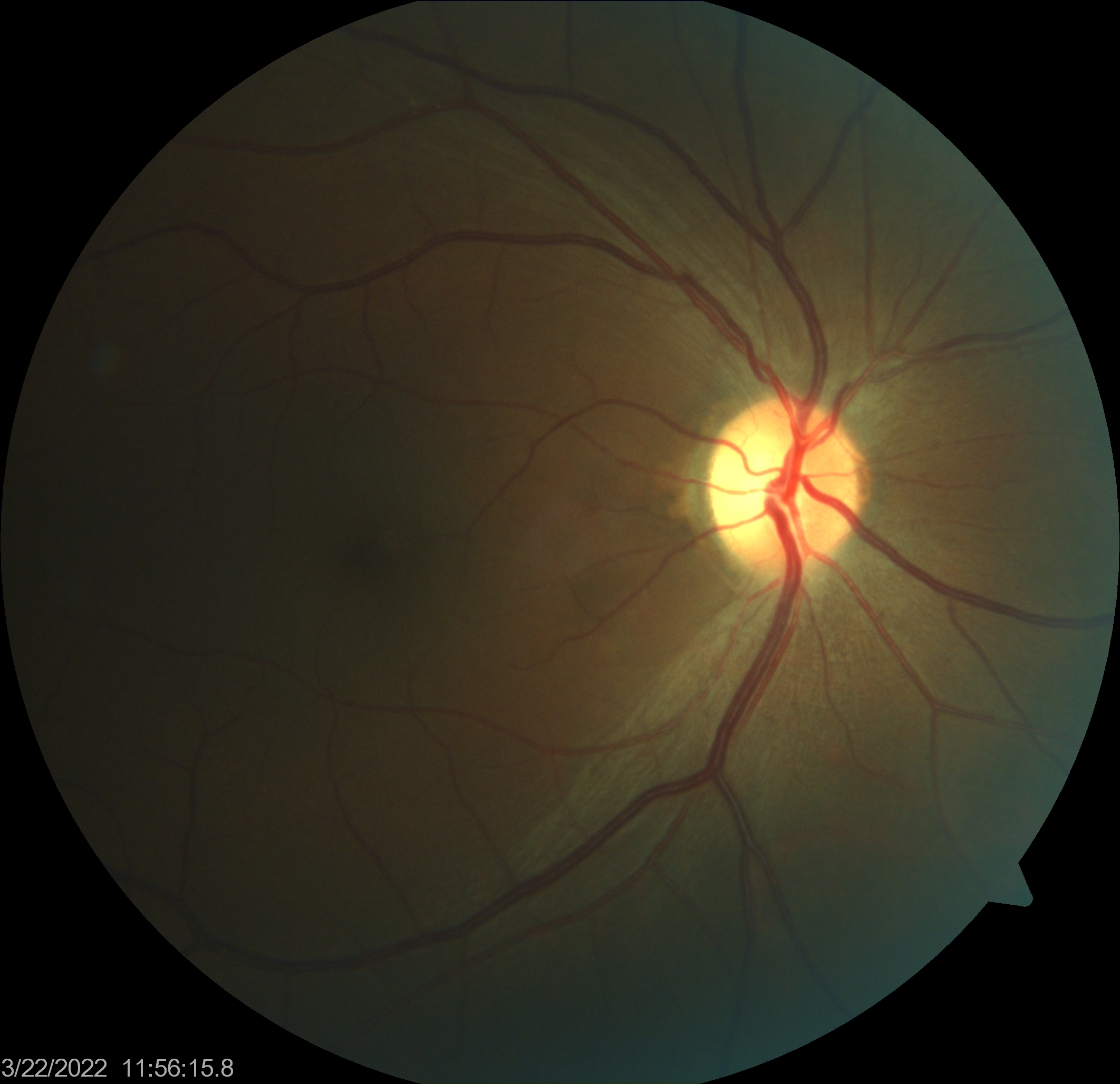 test-glaucoma-image3.jpg