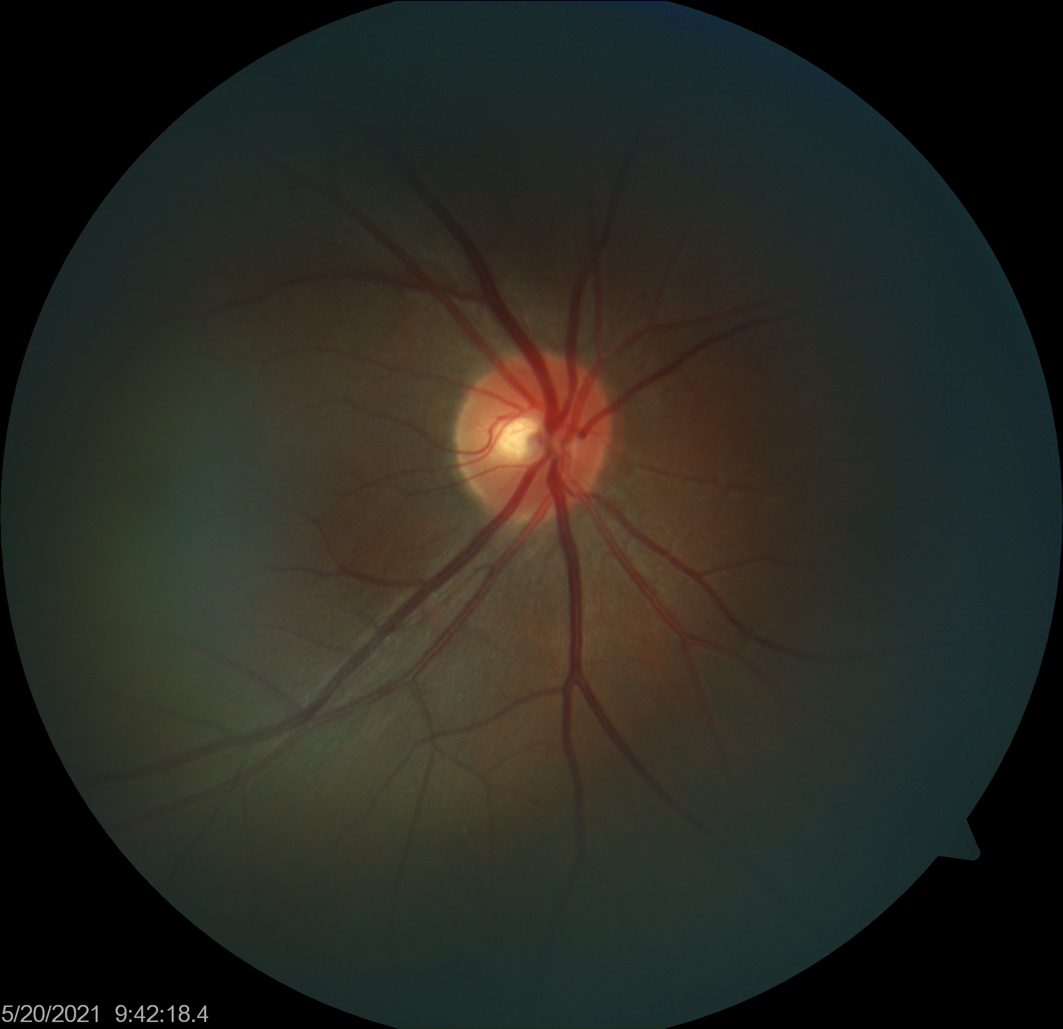 test-glaucoma-image4.jpg